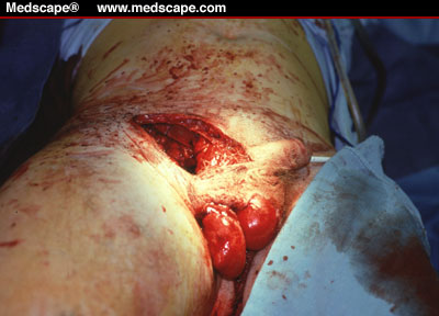 groin wound1