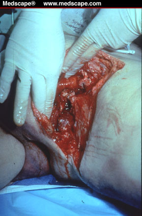 groin wound